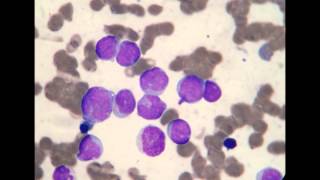 Acute Myeloblastic Leukemia M1 [upl. by Deva]