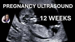 12 weeks pregnancy ultrasound video [upl. by Chessy]