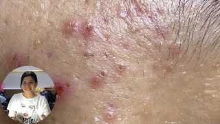 Acne Treatment Huong Da Nang The video has been lost for a long time Remove Blackheads [upl. by Elauqsap]