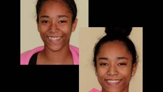 Underbite Correction in an Adolescent with Traditional Braces [upl. by Ennyleuqcaj]