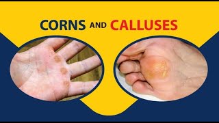 Calluses and Corns [upl. by Ettesoj]