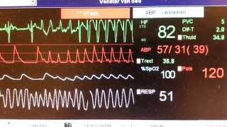 SVT adenosine brady VT SVT [upl. by Susie560]