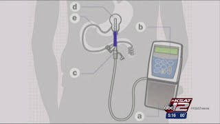 HealthBeat DUOPA for Parkinson’s Patients [upl. by Auqinihs]