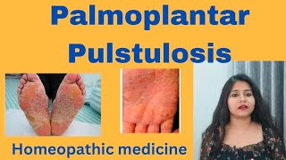 Palmoplantar Pulstulosis treatment  Palmoplantar Pulstulosis symptomscauses amp homeopathic medicine [upl. by Akihsat]