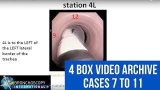 Bronchoscopy EBUS TBNA  4 Box Video Archive cases 7 to 11 [upl. by Hayne413]