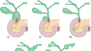 Choledochal cyst surgeryeducation neetpg [upl. by Tartaglia]