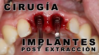 IMPLANTES POST EXTRACCION · IMPLANTES DENTALES MADRID · DR ISMAEL SORIANO [upl. by Yeclehc]