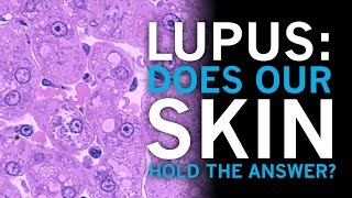 Lupus  Does our skin hold the answer [upl. by Vargas]