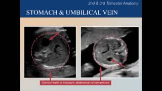 Abdomen  Stomach umbilical vein ultrasound [upl. by Ayel]