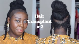 My 2nd Hair Transplant [upl. by Dearborn]