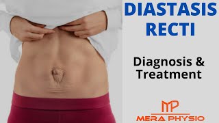 Diastasis Recti Abdominal Separation  Diagnosis Treatment amp Exercises  In Hindi  Mera Physio [upl. by Kuhn]