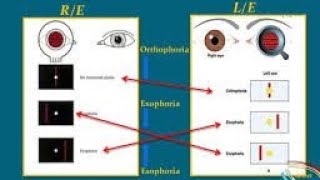 Maddox Rod Test  How to measure phoria ft Krishna kumar gupta Optometry goals [upl. by Glassco923]