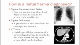 Hiatal Hernias [upl. by Nerland]