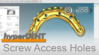 hyperDENT Tutorial Angulated Screw Channels [upl. by Trask]