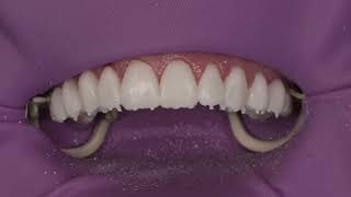 Clinical Tip on veneer temporization [upl. by Aunson]