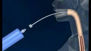 Intragastric Balloon [upl. by Adnawyek]