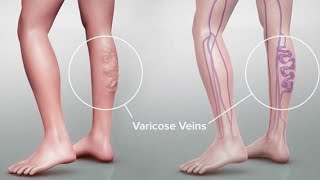 Varicose Vein Symptoms and Treatment in Tamil Health tips [upl. by Emrich]