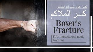 كسر الملاكم  كسر عنق مشط اليد الخامس boxers fracture  5th metacarpal neck fracture subtitled [upl. by Aurelius]