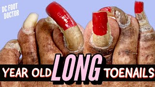 Year Old Long Toenails Trimming Extremely Long Toenails [upl. by Flory]