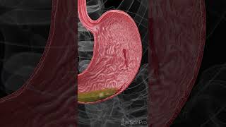 Understanding Hemorrhagic Gastric Ulcers anatomy meded 3danimation [upl. by Nedmac832]