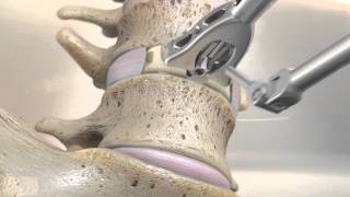 STALIF M™ MIDLINE II Surgical Technique Animation  Anterior Lumbar Interbody Fusion [upl. by Jacoby]