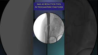 Nail as reduction tool in IT trochanteric fractures fracture trauma hip nail orthopedic s edic [upl. by Faso671]