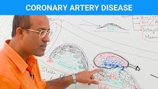 Coronary Artery Disease  Ischemic Heart Disease  Angina🫀 [upl. by Sondra]