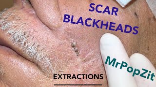 Giant blackheads imbedded in scar tissue extracted Common occurrence with surgical procedures [upl. by Asreht202]