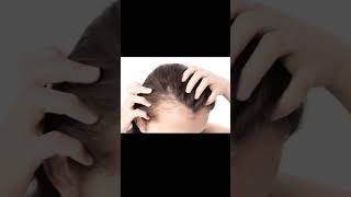 Do you have Hyperandrogenism with PCOS acne excessive hair irregular periods hair loss [upl. by Steffen206]