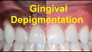 All about Gingival Pigmentation and Depigmentation [upl. by Kumagai]