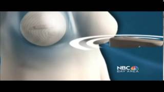 New Breast Reconstruction Implant May Improve Patient Comfort [upl. by Heilman]