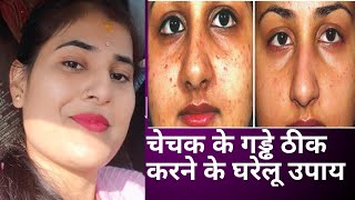 चिकन पॉक्स या चेचक के निशान कैसे हटाये  Chechak Ke daag aur gadde ka ilaj  scars  smallpox [upl. by Brody]