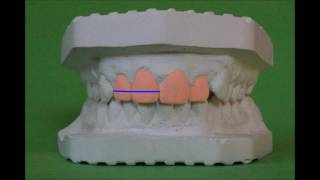 Orthodontic model analysis in Permanent Dentition [upl. by Einnol262]