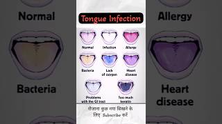 Tongue Infection Disease dadhichsir neet youtubeshorts infection [upl. by Aiceled84]