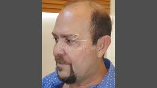 Hair Transplant Result Dr Felipe Pittella  Brazil [upl. by Jaala]