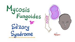 Mycosis Fungoides and Sèzary Syndrome  Hematology amp Oncology [upl. by Htyderem983]