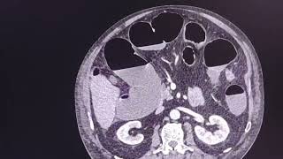 Large bowel obstruction  colonic tumour  step by step approach  Radiologists point of view [upl. by Enitsyrhc510]