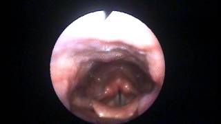 Elda Koutsoubaki  Voice Therapist demonstrating various voice onsets with nasendoscopy [upl. by Lamhaj]