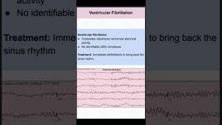 Ventricular Fibrillation [upl. by Ecnadnac]