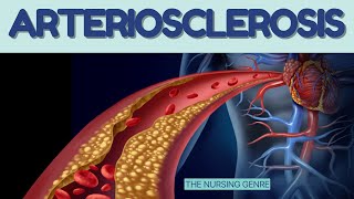 ARTERIOSCLEROSIS  Types  causes  Risk factors  clinical features atherosclerosis [upl. by Eniotna504]