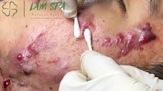 Treatment of acne pustules severe inflammation  Điều trị mụn mủ viêm nặng  LAMSPA PHUQUOC L P11 [upl. by Atiuqehs]