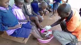 Anti jigger campaign MUSA PRIMARY SCHOOL a kid with scabies treated [upl. by Ilram]