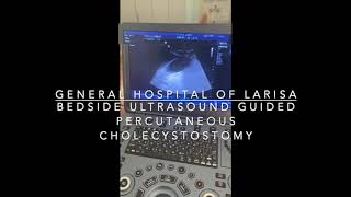 Bedside Ultrasound Guided Percutaneous Cholecystostomy [upl. by Weatherby]