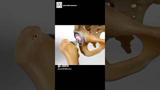 Total Hip Replacement Procedure  Animation [upl. by Einnalem383]