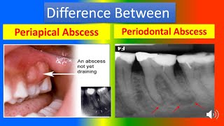 Difference Between Periapical Abscess and Periodontal Abscess [upl. by Lysander]