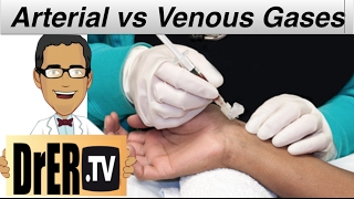 venous vs arterial blood gasses in the ER  medical minute [upl. by Scottie747]