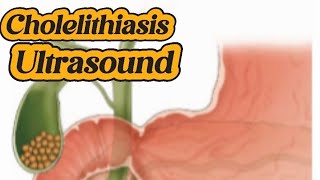 How to scan Gallstones  Cholelithiasis  calcified wall  cholecystitis  Sludge  Liver Ultrasound [upl. by Atsilac]