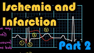 Ischemia Infarction and the Waveforms Q through U Part 2 How to Read an EKG Curriculum [upl. by Nimajnab]