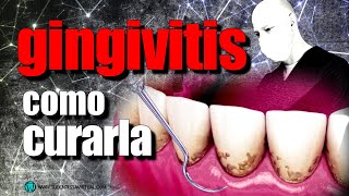 🔵TRATAMIENTO EFECTIVO de la GINGIVITIS y la PERIODONTITIS [upl. by Ytirahs]