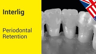 INTERLIG  Periodontal Retention [upl. by Ymot89]